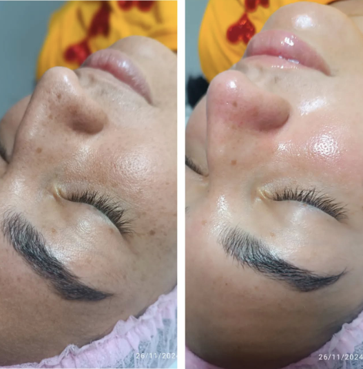 Produto de limpeza facial com propriedades clareadoras e anti-inflamatórias