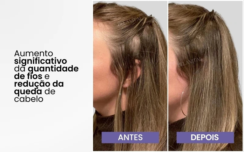 Escova Massageadora Capilar com Laser 4 em 1 – Tratamento Antiqueda