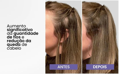 Escova Massageadora Capilar com Laser 4 em 1 – Tratamento Antiqueda